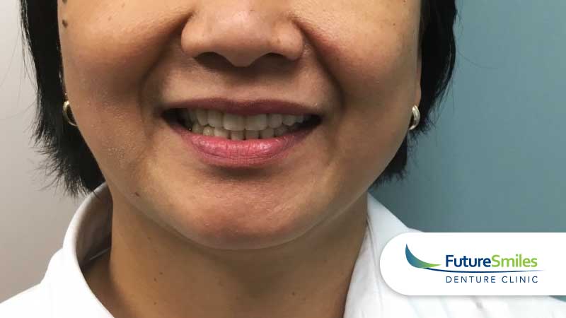 Patient case #2 after treatment at Future Smiles