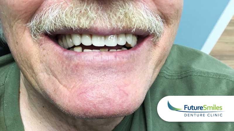 Future Smiles patient case #4