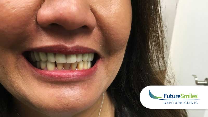 Future Smiles patient case #1
