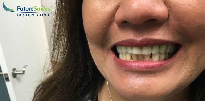 Repairing Ill-Fitting Dentures