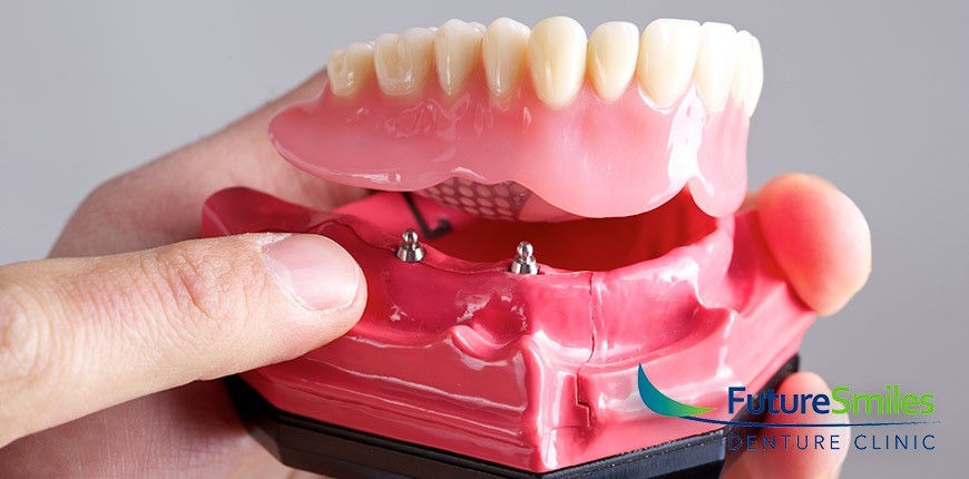 A Dental Implants Revolution