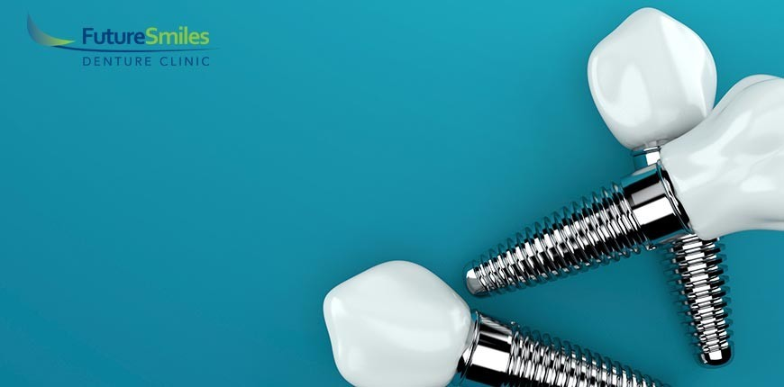 Choosing The Right Material For Your Dental Implant