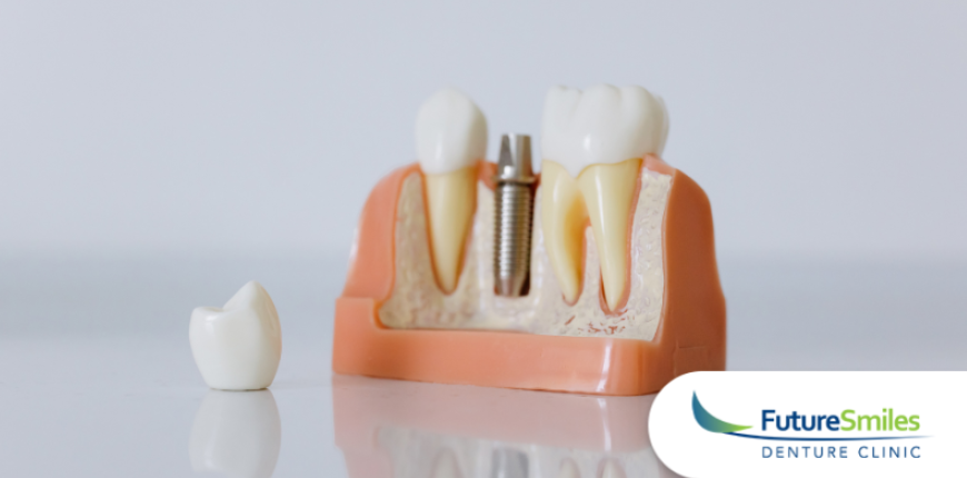 Why Implant Supported Dentures Are the Future of Smile Restoration in Calgary 
