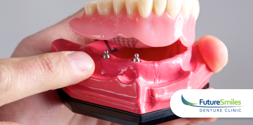 Complete vs. Partial Dentures: What’s Right for Your Smile? 