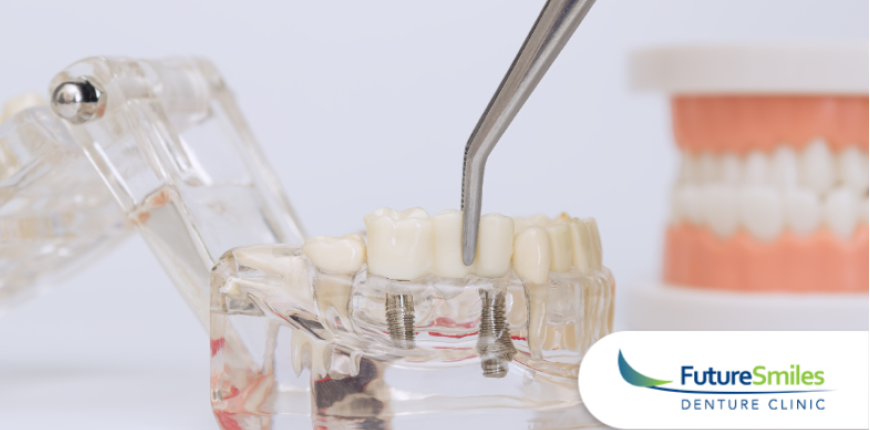 Are Implant-Supported Dentures Right for You? Pros, Cons, and Alternatives 