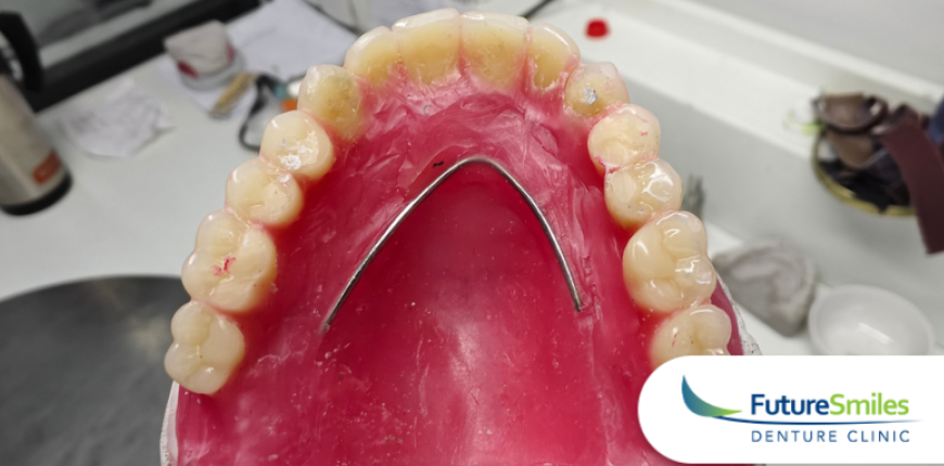 Denture Reline or Rebase: What’s the Difference and Which Do You Need? Denture Reline or Rebase: What’s the Difference and Which Do You Need?