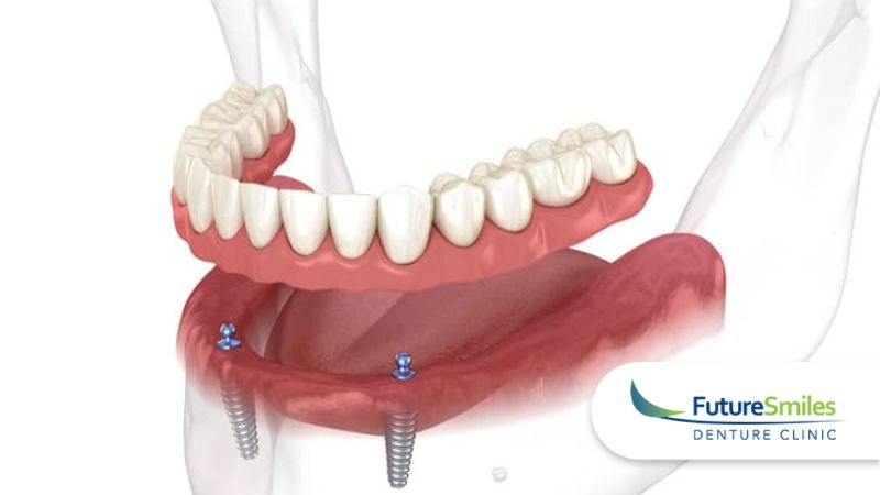 The Benefits Of All-On-4 Denture Implants