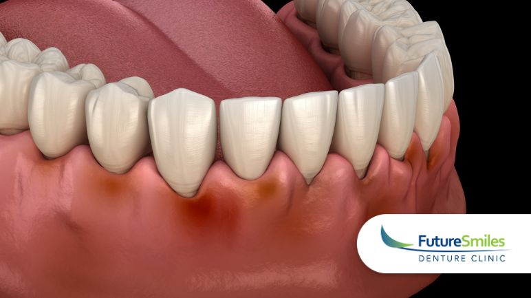 Preventing and Managing Gum Disease for Denture Wearers