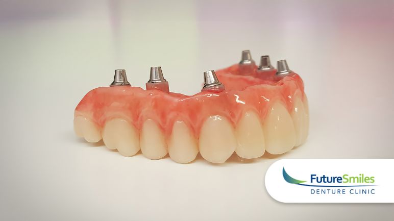 Calgary Denture Implants: The Difference Between Traditional Dentures and Denture Implants