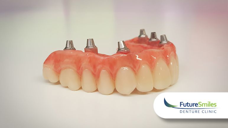  The Cost of SE Denture Implants: 5 Factors That Affect Pricing