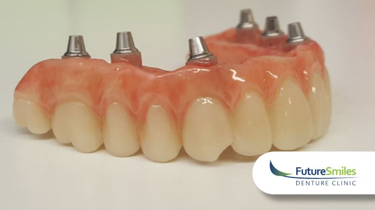  SW Calgary: 5 Reasons Why Denture Implants Are Worth the Investment