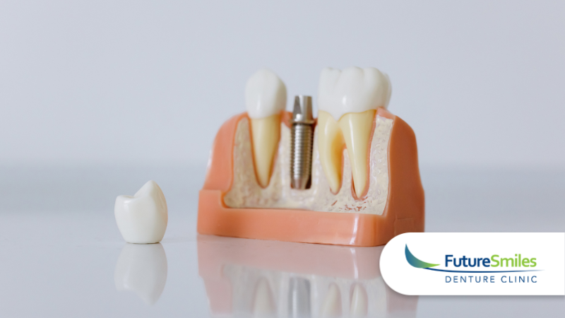 Why Implant Supported Dentures Are the Future of Smile Restoration in Calgary 