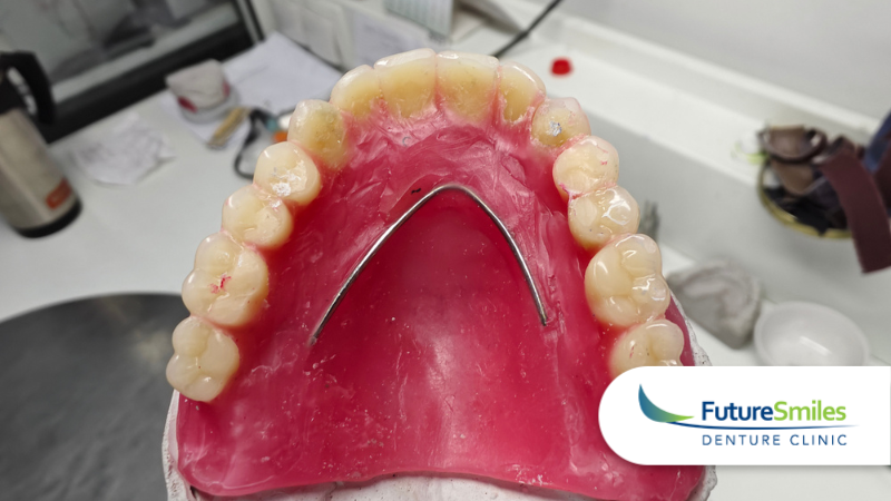 Denture Reline or Rebase: What’s the Difference and Which Do You Need? 