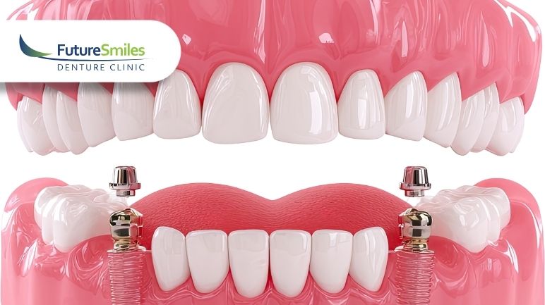 What Are Denture Implants and Who Are They Best For? – Calgary Denture Implants